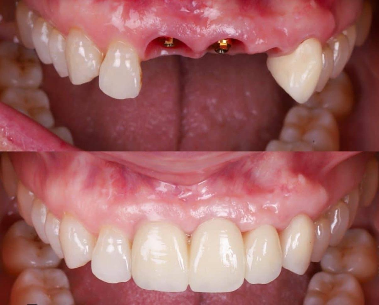 Implantes dentales en Córdoba